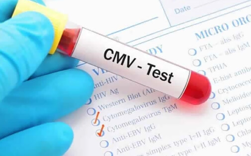 CMV IGG Pozitif Ne Demek Op Dr Ceylan lhan cmv-igg-pozitif-ne-demek-op-dr-ceylan-lhan